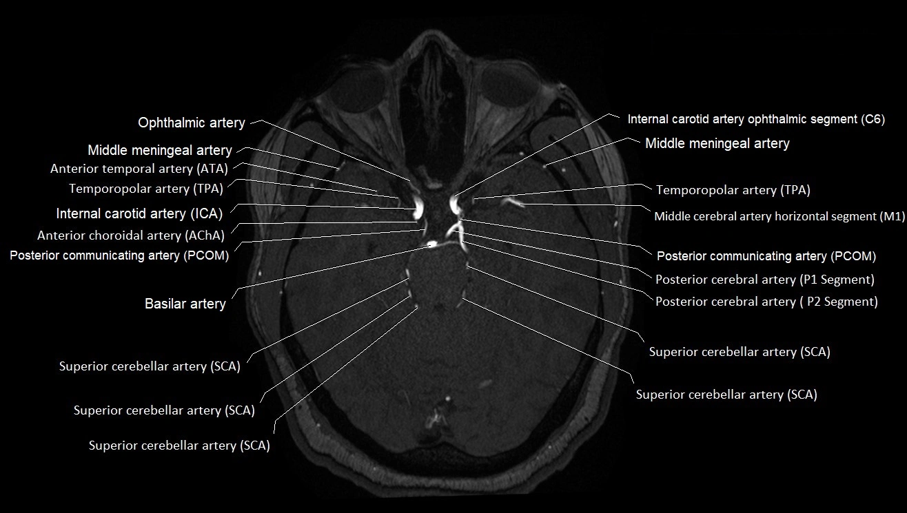 MRA brain (cerebral arteries) anatomy axial 3T image 13.webp